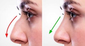 Nose Job in Dubai
